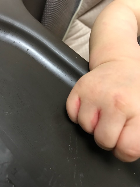 赤ちゃんの指の間が赤いブツブツが発生した体験談 湿疹の原因と対処 日々のお助け情報