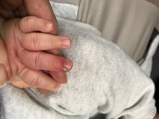 赤ちゃん爪の横の膿-4