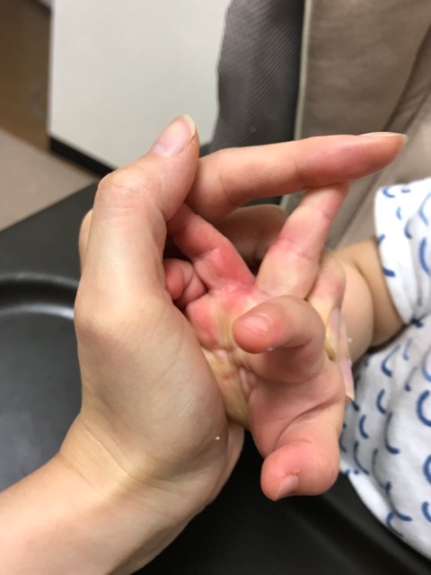 赤ちゃん-手の間の湿疹-01